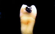 Bolest po vytržení zubu