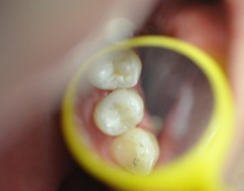 Váček pod zubem léčba