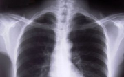 Rakovina plic a metastáze do kosti